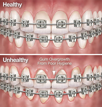 ow to keep teeth clean with braces