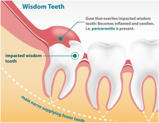 Pericoronitis WORLD CLASS DENTAL CLINIC PUNE Pericoronitis WORLD CLASS DENTAL CLINIC PUNE