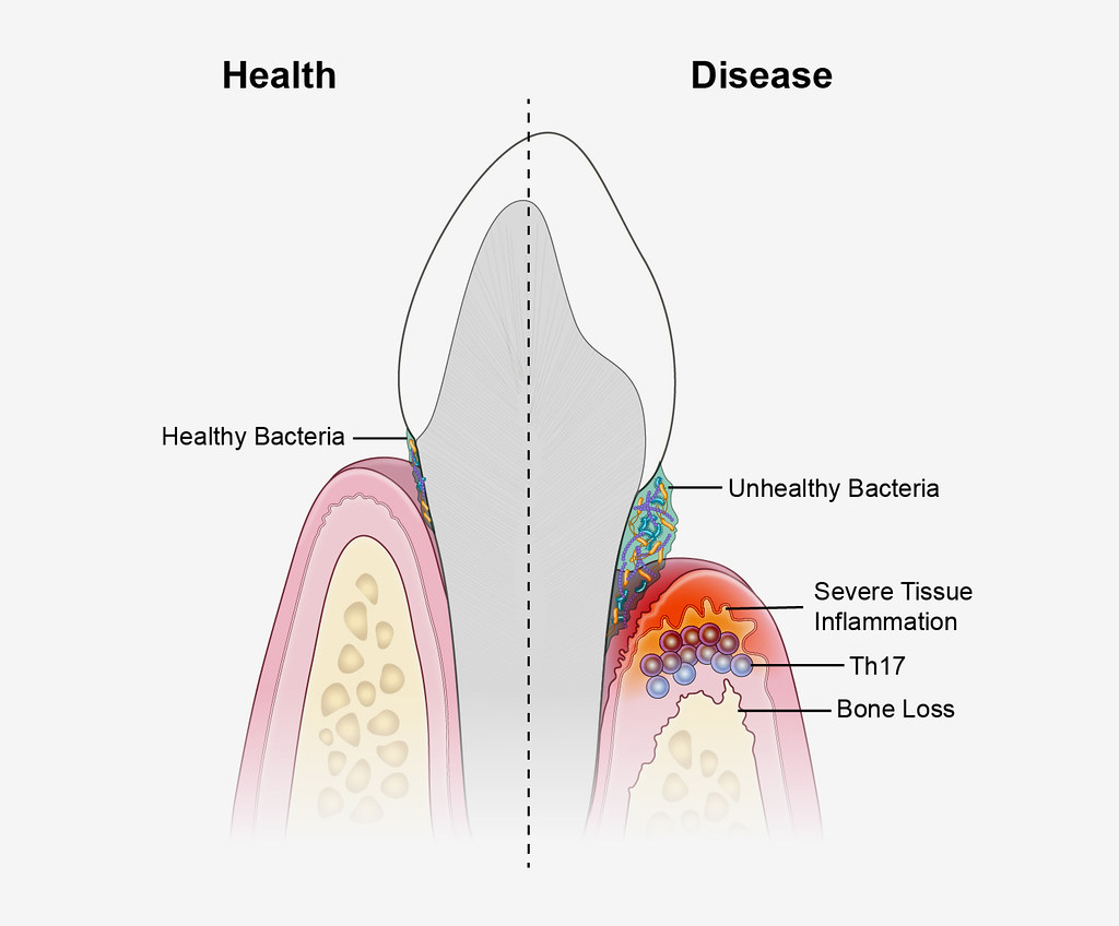 gingival and periodontal diseases
