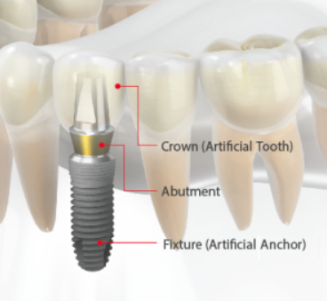 dental implants treatment in pune